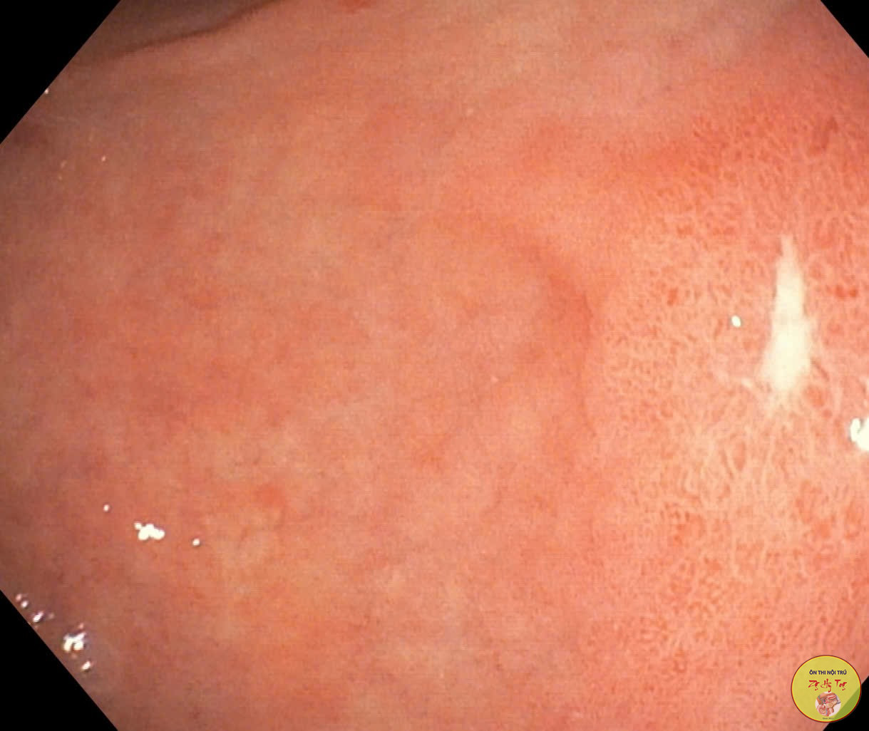 CHẾ ĐỘ ĂN CHO NGƯỜI VIÊM DẠ DÀY MẠN TÍNH