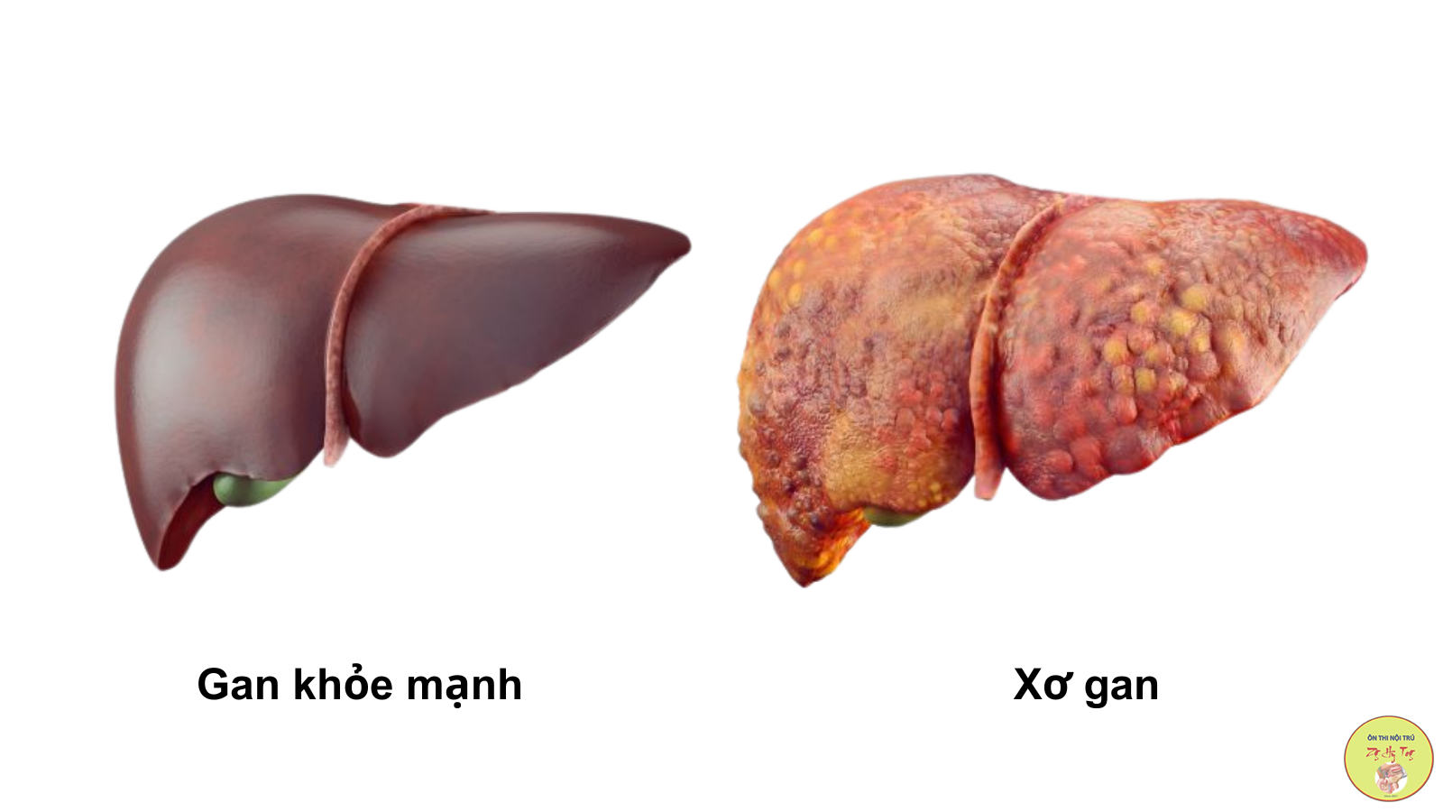 CHẾ ĐỘ DINH DƯỠNG CHO BỆNH NHÂN GAN MẬT, XƠ GAN