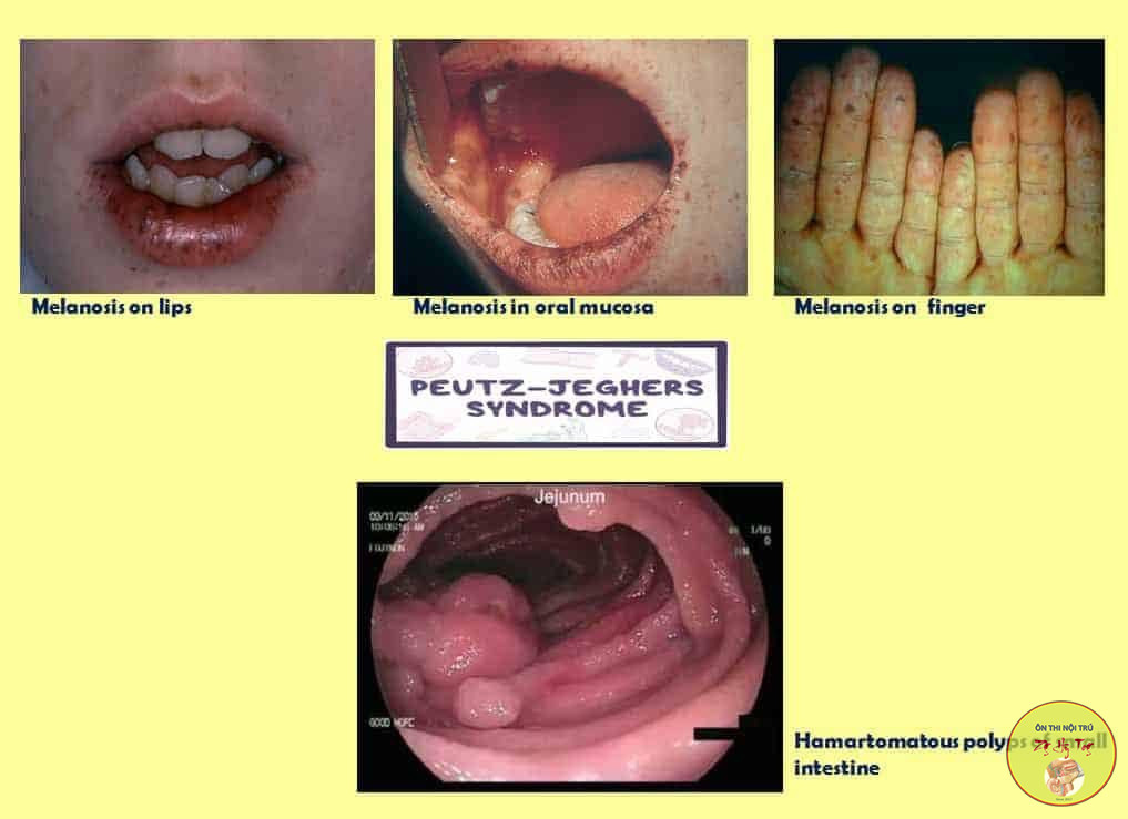 ĐA POLYP DẠ DÀY ĐẠI TRÀNG