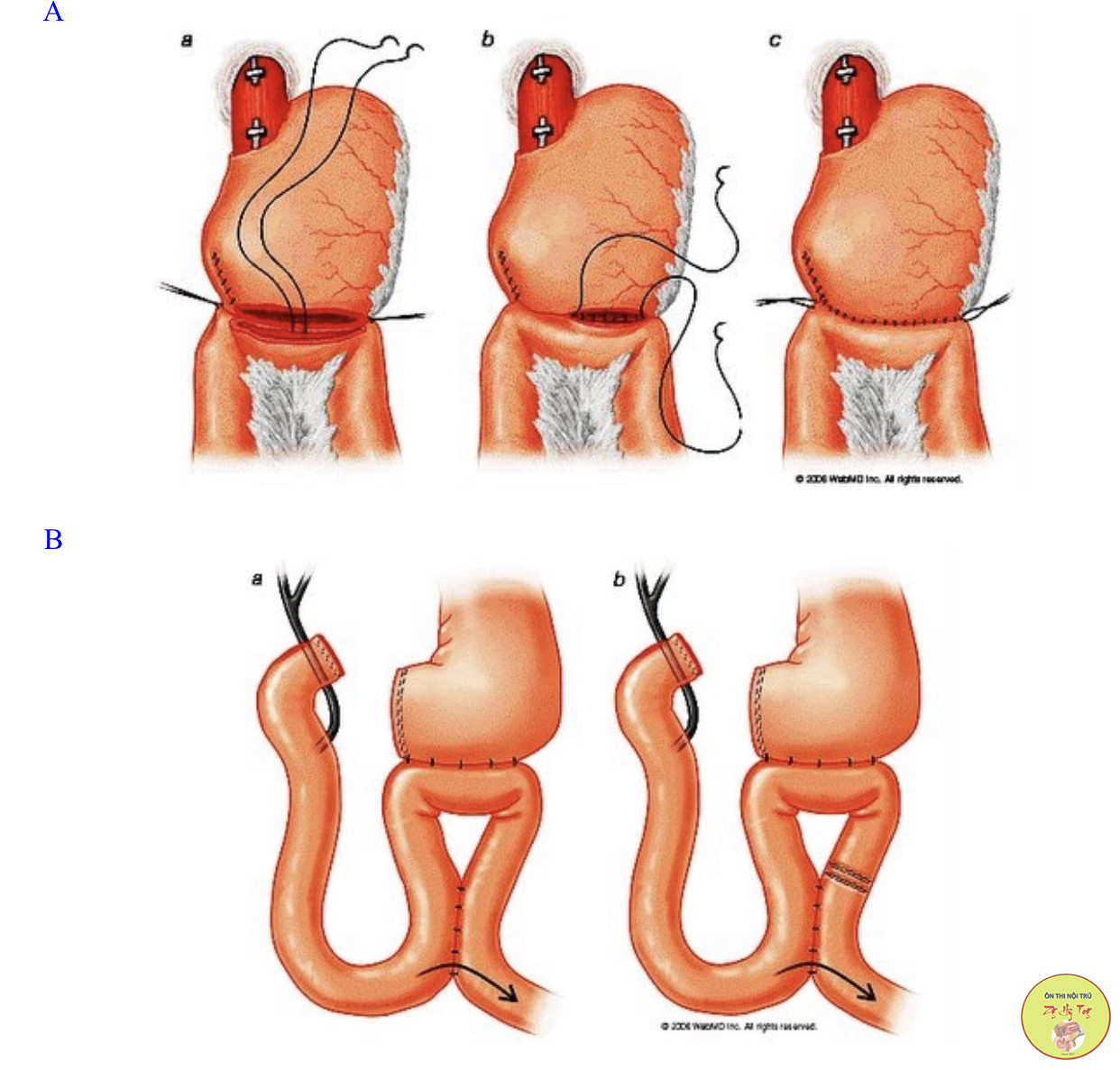 4. So sánh giữa Phẫu thuật Billroth 1 và Billroth 2