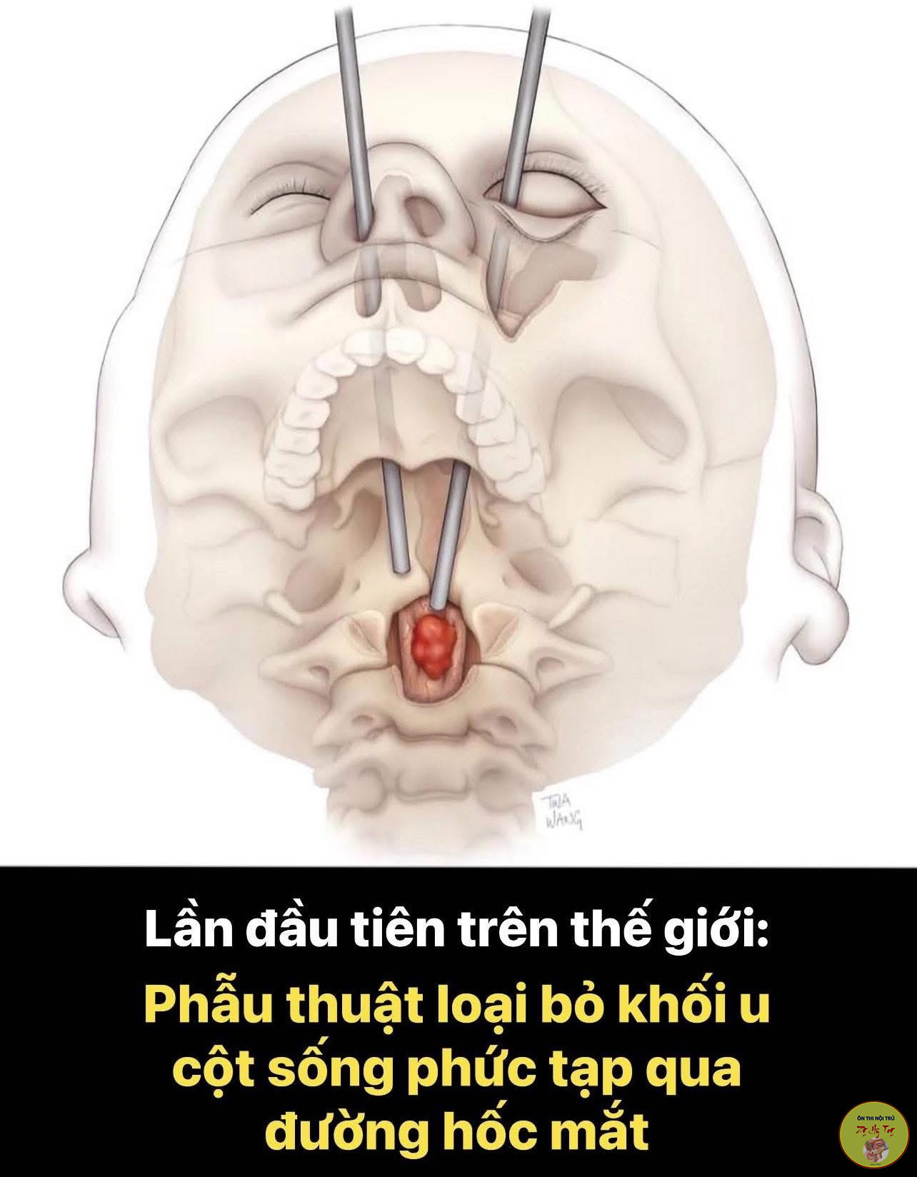 PHẪU THUẬT CỘT SỐNG