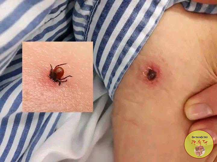 SỐT MÒ VÀ NHỮNG ĐIỀU CẦN BIẾT