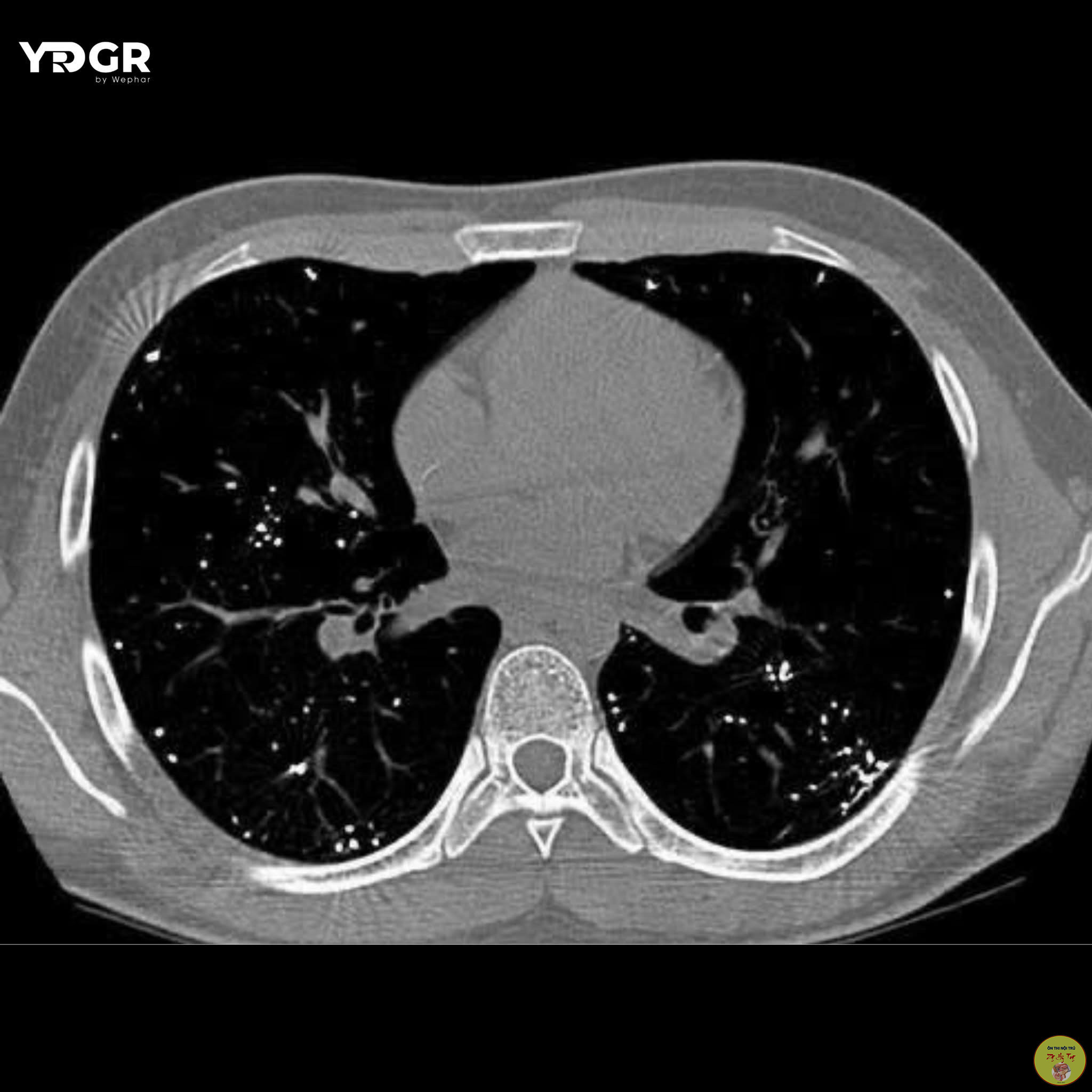 VỠ NHIỆT KẾ THUỶ NGÂN