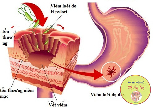 VIÊM LOÉT DẠ DÀY