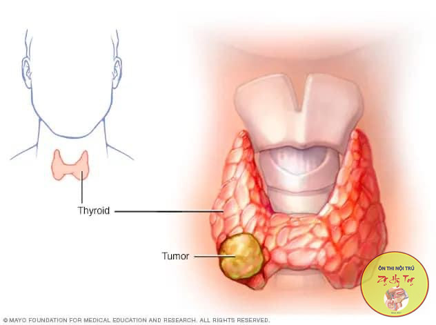 CHẨN ĐOÁN UNG THƯ TUYẾN GIÁP