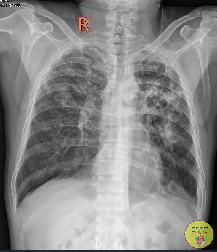 XQUANG LAO PHỔI - ĐỌC