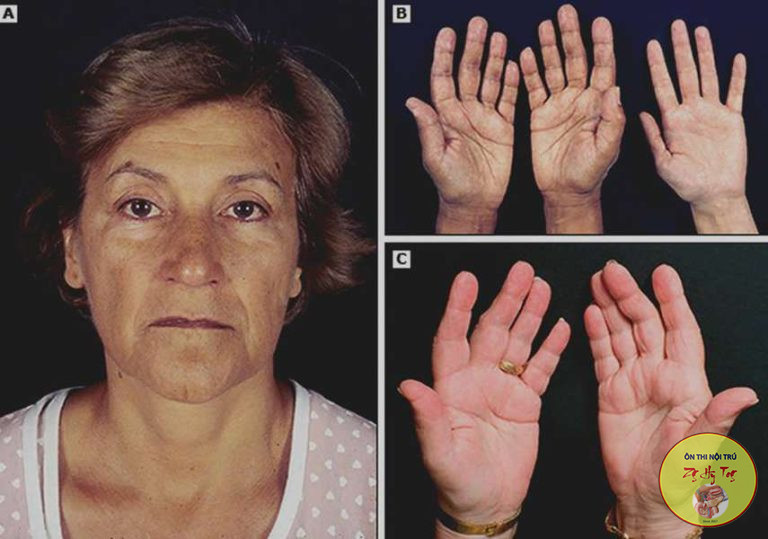 BỆNH NHÂN MỆT ĐI KHÁM PHÁT HIỆN SUY THƯỢNG THẬN