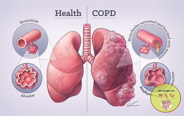 TỔNG QUAN CHẨN ĐOÁN BỆNH PHỔI TÂC NGHẼN MẠN TÍNH COPD