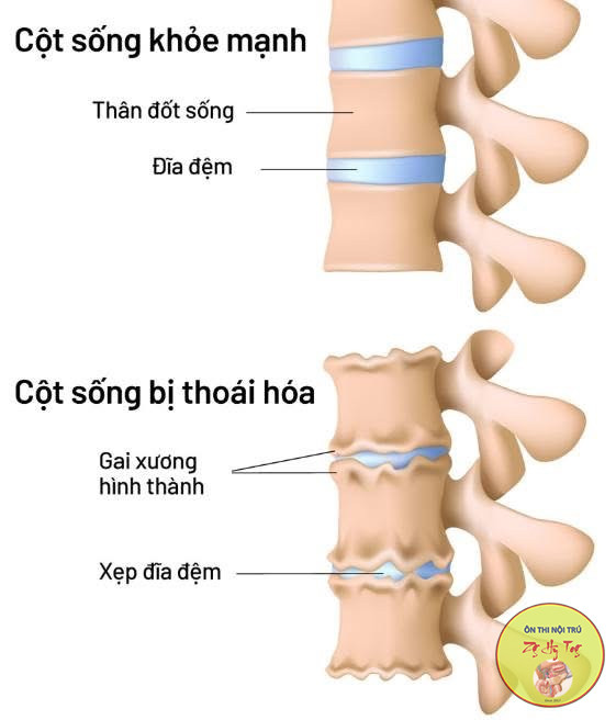 CÁC LOẠI GAI XƯƠNG THƯỜNG GẶP