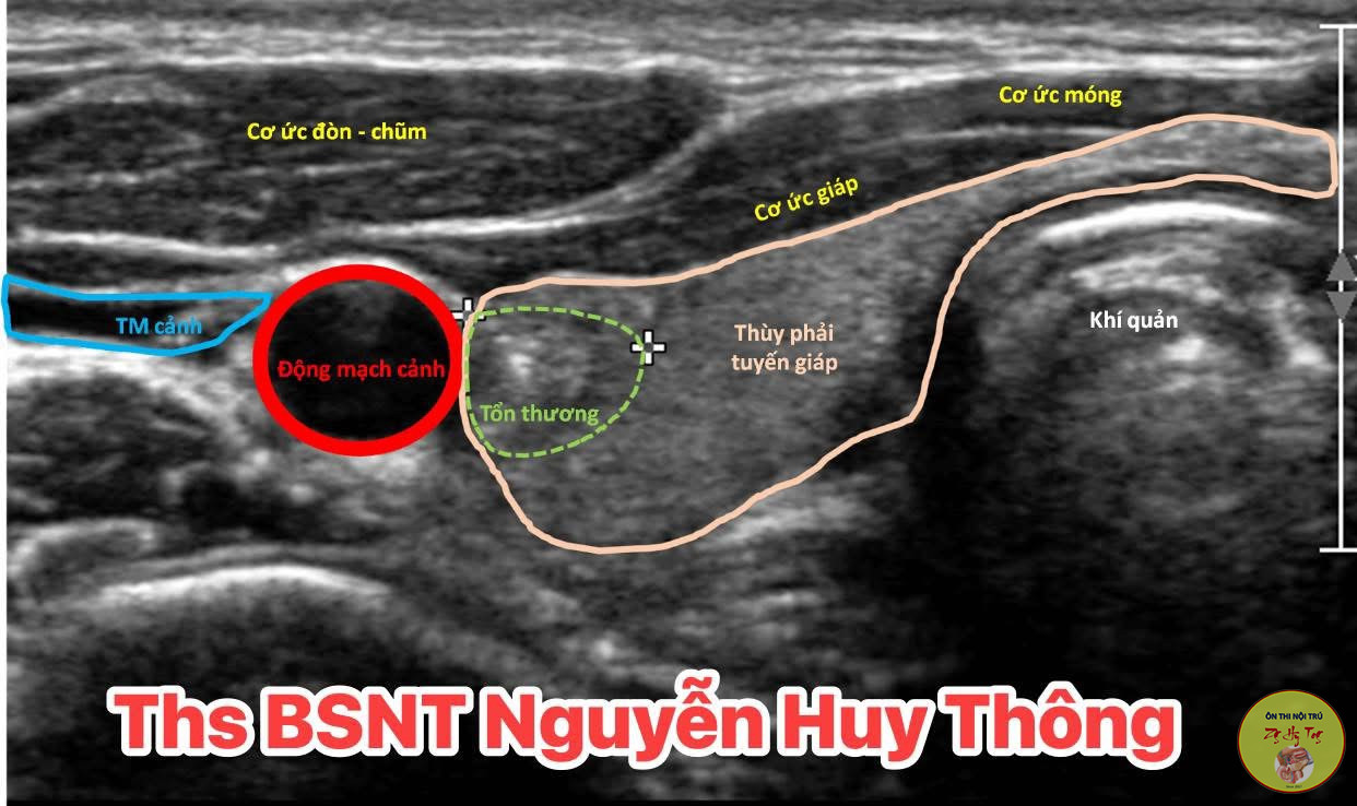 SIÊU ÂM TUYẾN GIÁP