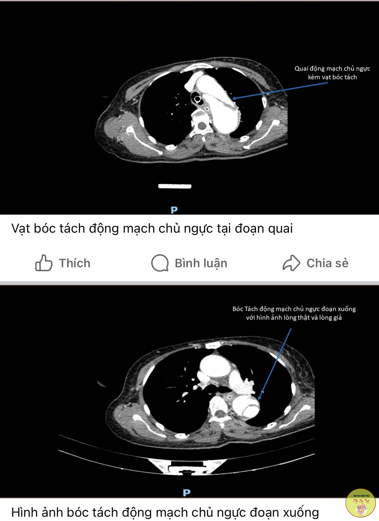 TĂNG HUYẾT ÁP KHÔNG ĐƠN GIẢN, CA LÂM SÀNG HAY